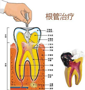 根管治疗