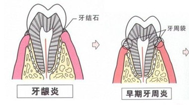 牙周治疗